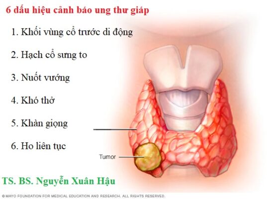 U tuyến giáp ác tính