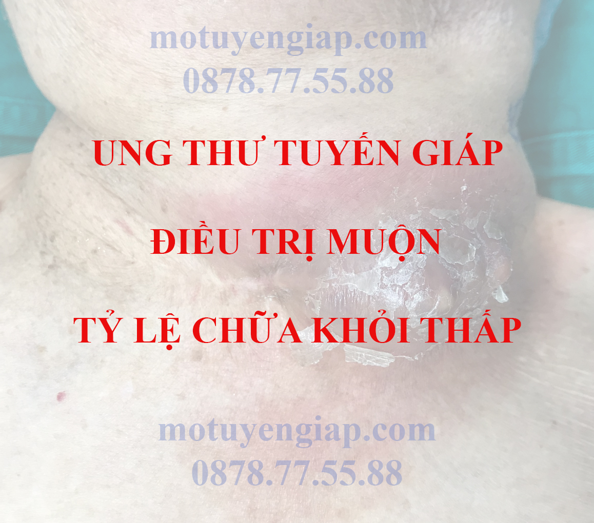 K giáp thể nhú