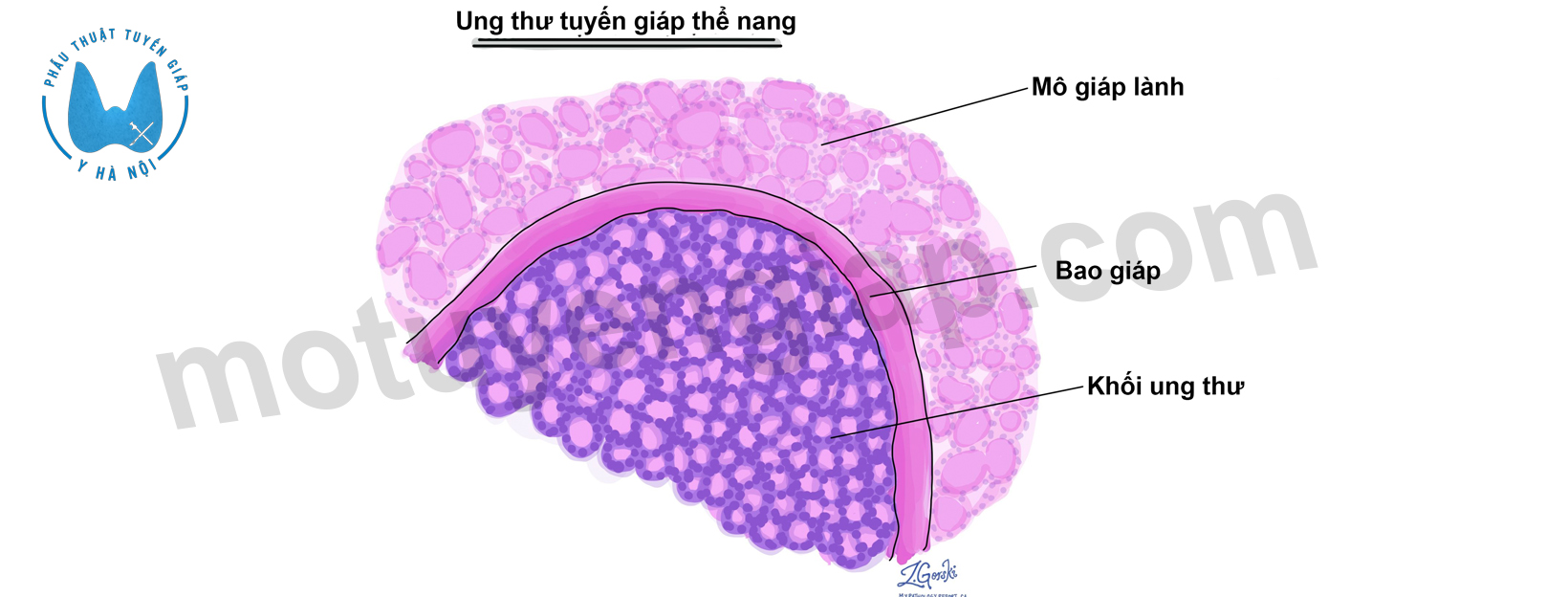 ung thu giap