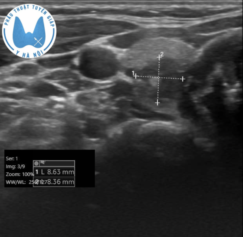 Nhân tuyến giáp nhỏ – nhưng có thực sự là câu chuyện nhỏ? 7 Screenshot 2026 03 12 at 09.33.27