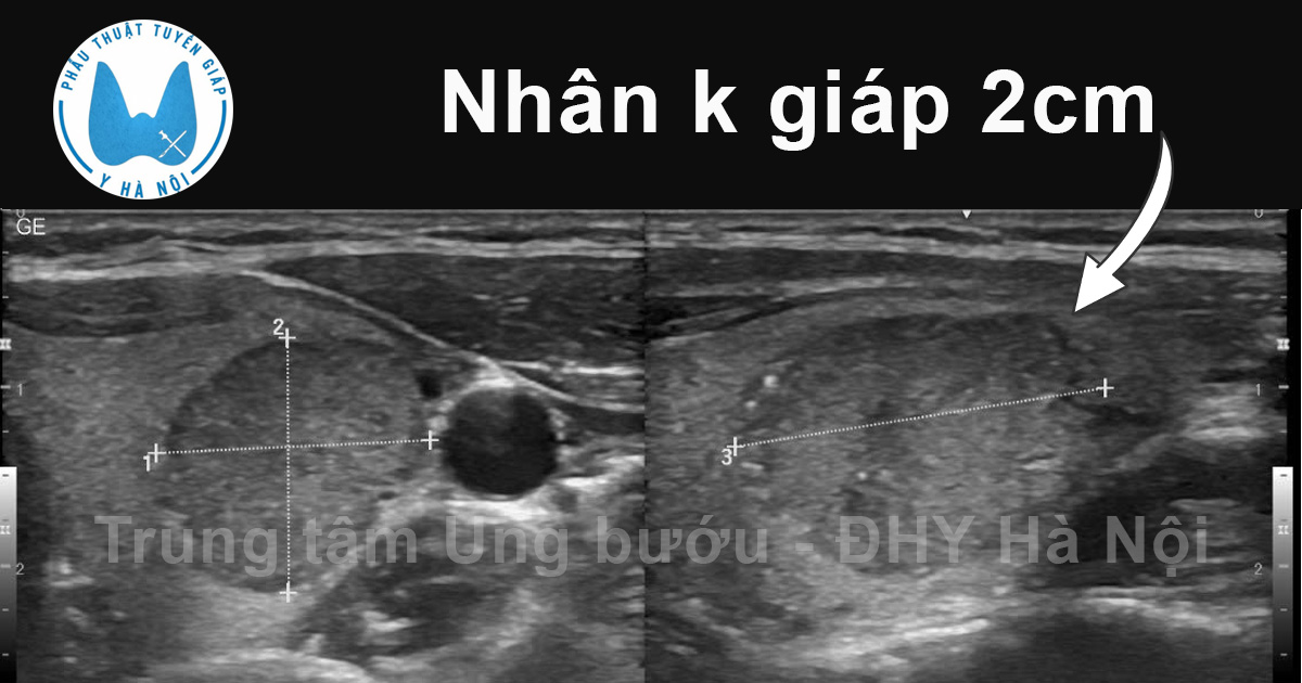 Nhân K tuyến giáp lớn… nhưng lại là một câu chuyện nhỏ 3 Untitled 1 copy